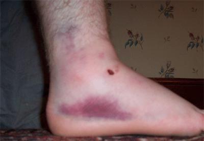 my ankle