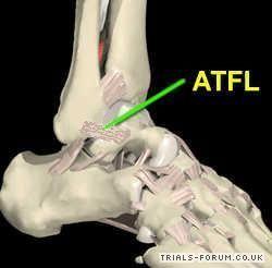 ankle internal misaligned atfl.JPG